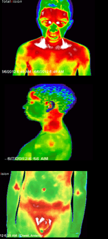 Pre Infrared Images of Child with Autism 